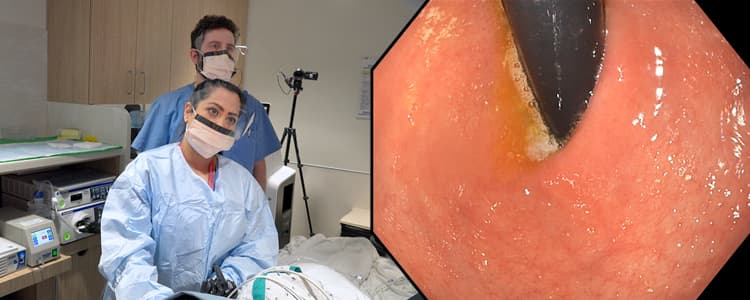 endoscopic-evaluation-of-a-twisted-gastric-sleeve-causing-severe-reflux-and-epigastric-pain