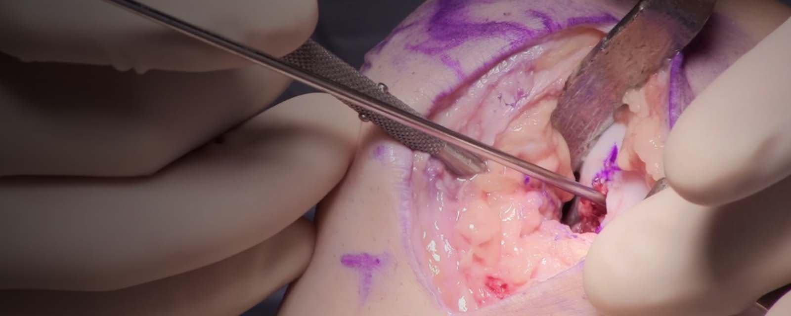 Femoral Resurfacing with an Osteochondral Allograft for Osteochondritis Dissecans
