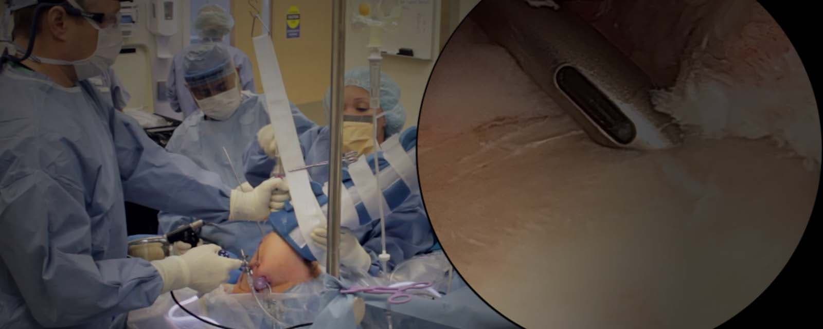 Arthroscopic Bankart Repair for Anterior Shoulder Instability Using a Posterolateral Portal