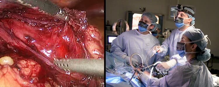 laparoscopic-heller-myotomy-and-partial-fundoplication-for-achalasia