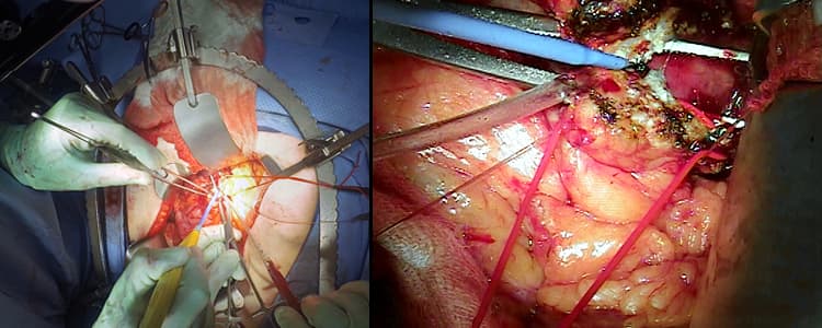 whipple-procedure-for-carcinoma-of-the-pancreas