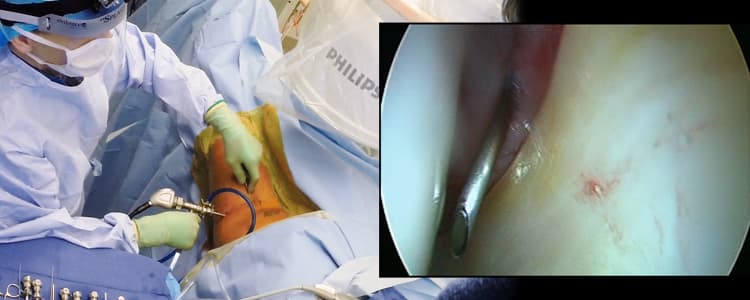 portal-placement-hip-arthroscopy