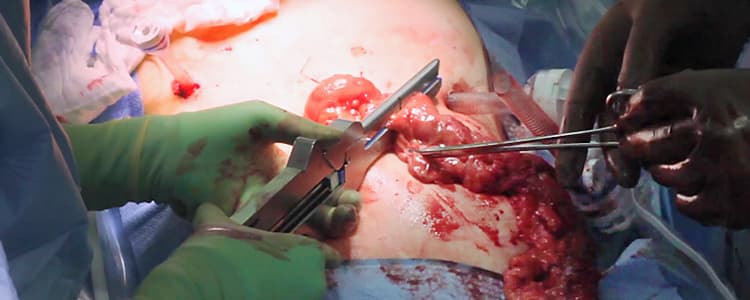 laparoscopic-sigmoid-resection-for-diverticulitis