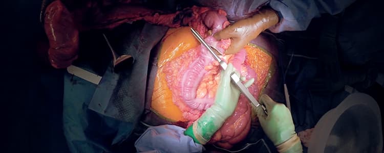 open-left-colectomy-for-colon-cancer:-left-colon-and-sigmoid-resection-with-colostomy-formation