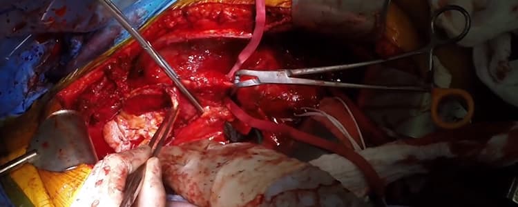 thoracoabdominal-aortic-aneurysm-repair