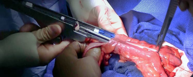 laparoscopic-right-colectomy-with-ileocolic-anastomosis