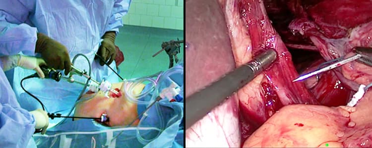 laparoscopic-paraesophageal-hernia-repair