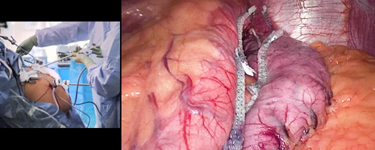 laparoscopic-sleeve-gastrectomy