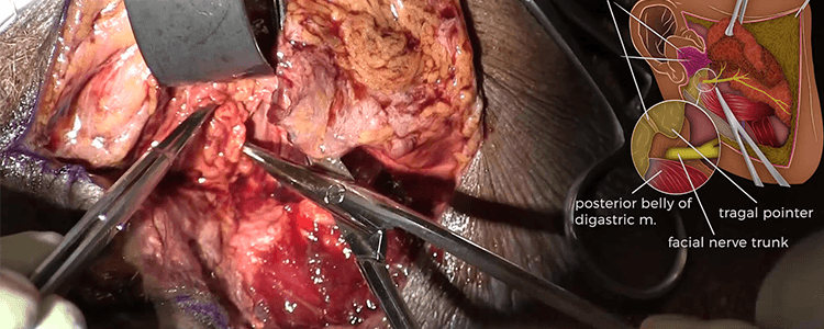 parotid-dissection