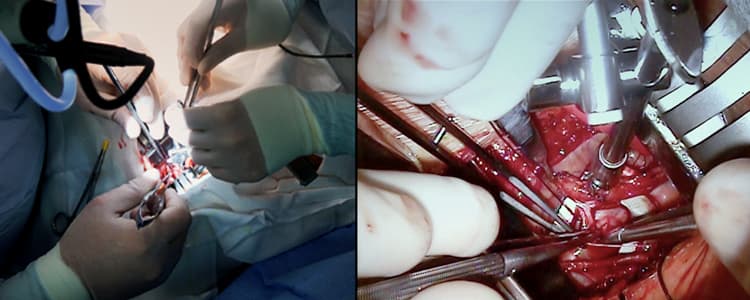 minimally-invasive-direct-coronary-artery-bypass-midcab