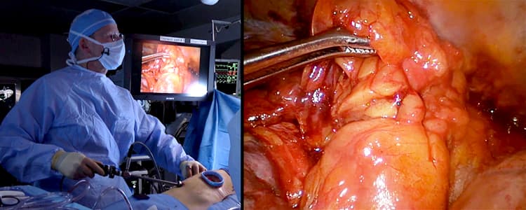 combined-thymectomy-and-right-lower-lobe-pulmonary-wedge-resection-by-thoracoscopy