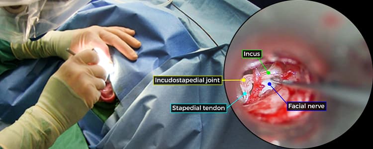 laser-stapedotomy-for-otosclerosis