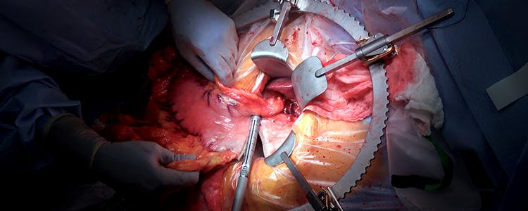open-distal-gastrectomy