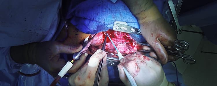 open-left-upper-lobectomy-in-an-adult-cystic-fibrosis-patient