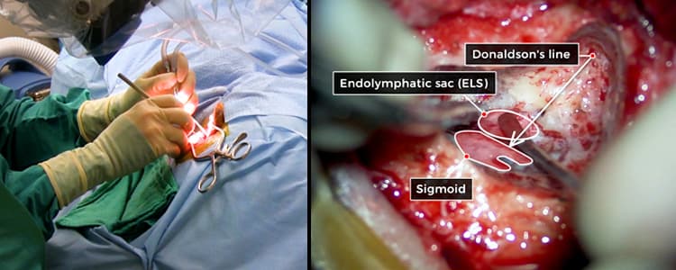 endolymphatic-sac-decompression