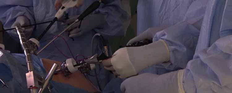 laparoscopic-nissen-fundoplication