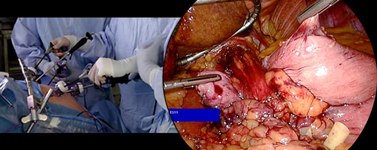 laparoscopic-nissen-fundoplication