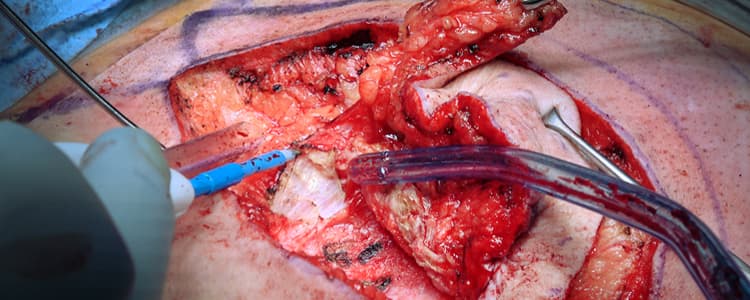 revision-bascom-cleft-lift-pilonidal-cystectomy