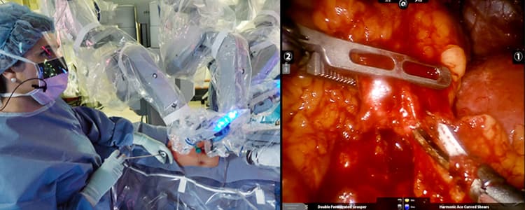 robotic-assisted-left-adrenalectomy