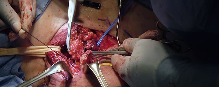 bilateral-modified-radical-neck-dissection