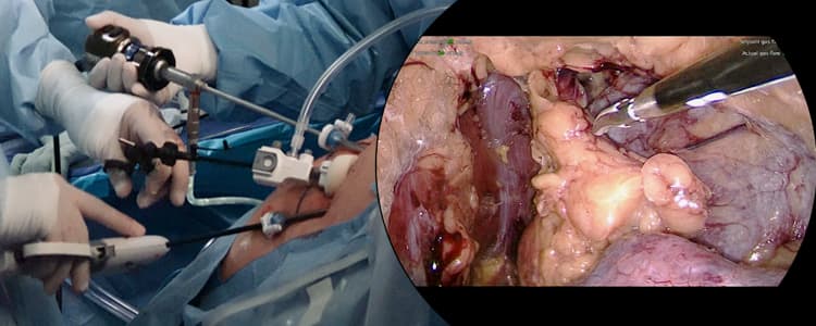 right-posterior-retroperitoneoscopic-adrenalectomy-(pra)-for-adrenocortical-adenoma