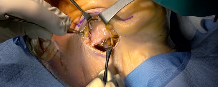 Submandibular-Approach-to-the-Mandible-(Cadaver)