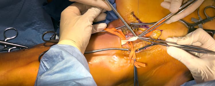 femoral-artery-cut-down-and-proximal-anastomosis-procedure-cadaver