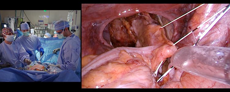 Laparoscopic-Suture-Rectopexy-with-Culdoplasty-Vaginal-Wall-Repair-and-Perineorrhaphy-for-Rectal-Prolapse