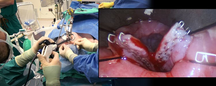 zenker's-diverticulum:-endoscopic-staple-assisted-diverticulotomy