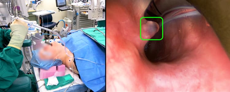 direct-microlaryngoscopy-and-excision-of-vocal-cord-lesion