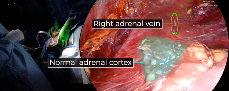 bilateral-posterior-retroperitoneoscopic-adrenalectomy-with-cortical-sparing-on-right-side