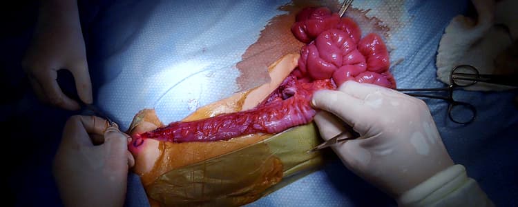 colon-interposition-to-replace-an-absent-esophagus-is-the-procedure-of-choice-in-low-income-countries
