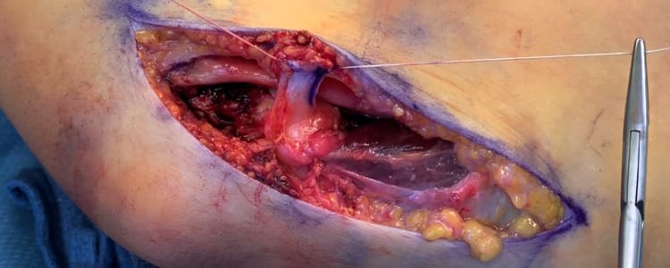 subcutaneous-ulnar-nerve-transposition