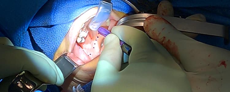 treatment-of-squamous-cell-carcinoma-from-the-posterior-maxilla-with-obturator-placement-and-ipsilateral-neck-dissection