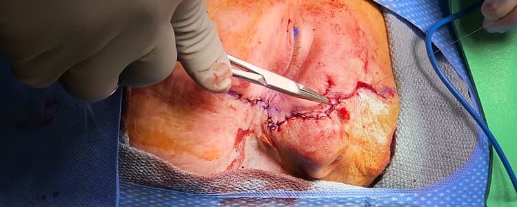 reconstruction-of-a-large-nasal-cutaneous-defect-using-nasolabial-and-rhomboid-flaps