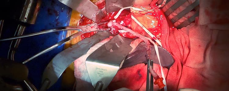 supraceliac-aorta-to-sma-bypass-with-ileocecectomy-for-acute-on-chronic-mesenteric-ischemia-complicated-by-bowel-necrosis-and-perforation