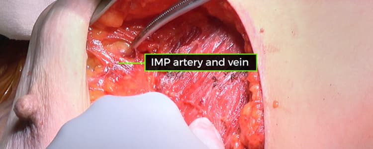 internal-mammary-perforator-preserving-nipple-sparing-mastectomy-(imp-nsm)-to-reduce-ischemic-complications