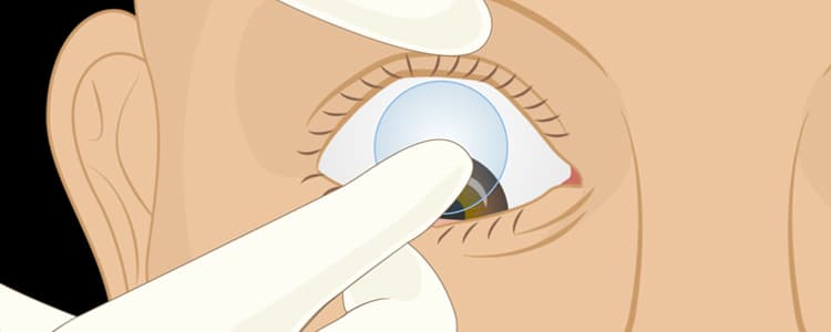 placement-and-removal-of-bandage-contact-lens