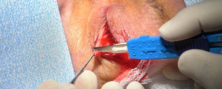 lateral-tarsal-strip-procedure-for-left-lower-eyelid-entropion