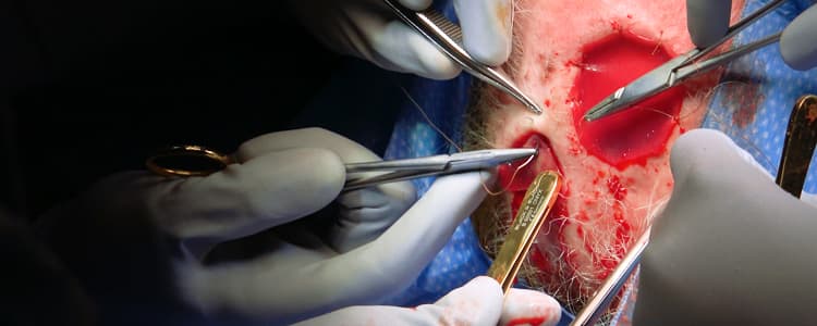 integra-scalp-reconstruction:-addressing-a-full-thickness-scalp-defect-with-exposed-calvarium-along-vertex-in-an-elderly-immunocompromised-patient