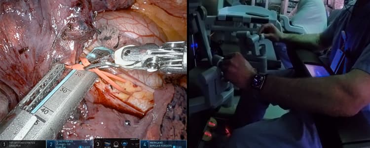 robotic-right-middle-lobectomy-and-mediastinal-lymph-node-dissection-for-adenocarcinoma