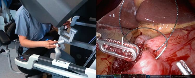 robotic-heineke-mikulicz-pyloroplasty-for-pyloric-stenosis