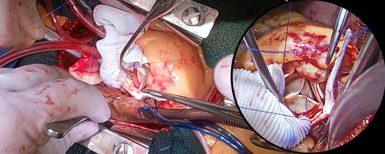 combined-replacement-of-aortic-valve-and-ascending-aorta-with-patent-foramen-ovale-pfo-closure