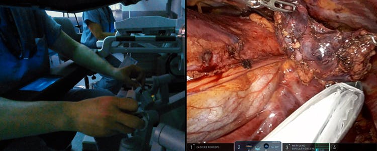 robotic-thymectomy-for-myasthenia-gravis