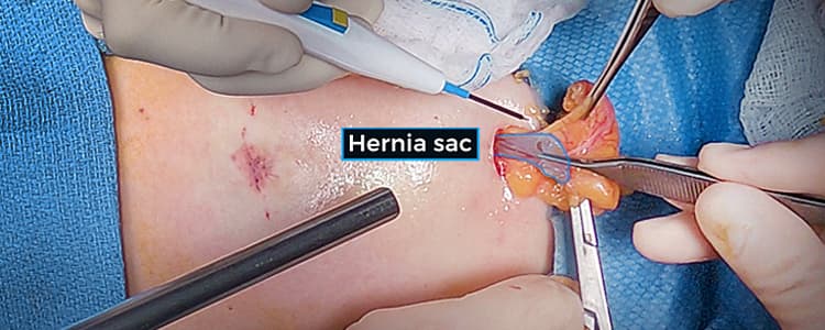 open-epigastric-hernia-repair-without-mesh-for-a-1-cm-incarcerated-hernia