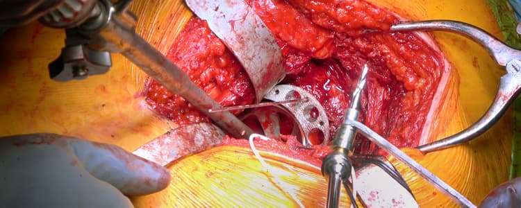 the-use-of-photodynamic-nails-for-bone-reinforcement-in-combination-with-complex-total-hip-arthroplasty-in-the-setting-of-radiation-osteitis