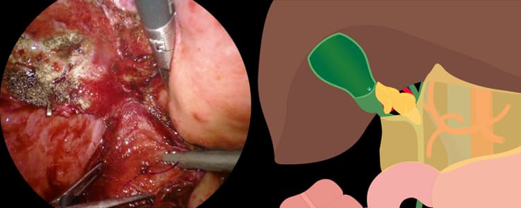 laparoscopic-subtotal-fenestrating-cholecystectomy-in-a-cirrhotic-patient