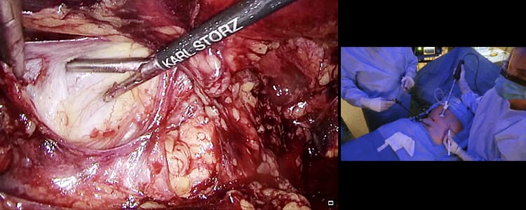 laparoscopic-totally-extraperitoneal-tep-left-indirect-inguinal-hernia-repair-with-mesh