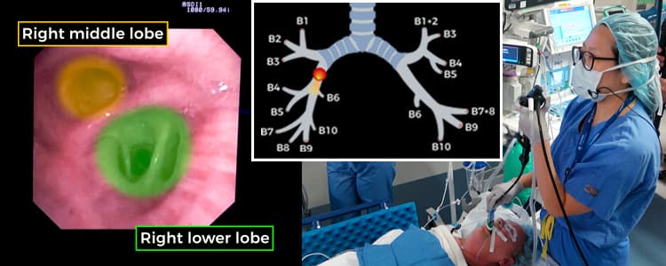 flexible-bronchoscopy-and-bronchoalveolar-lavage-(bal)