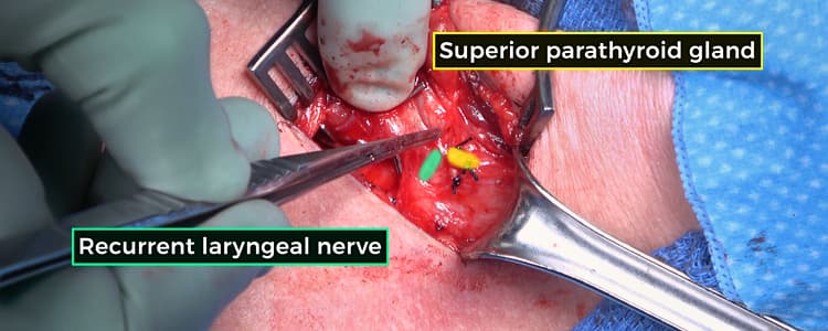 open-total-thyroidectomy-for-graves-disease